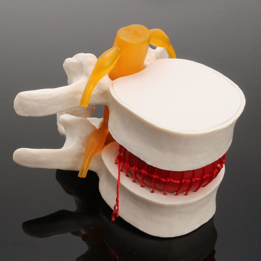Demonstrationsmodell Intervertebraldisk-Hernie – Bild 7 | LuxeStyle