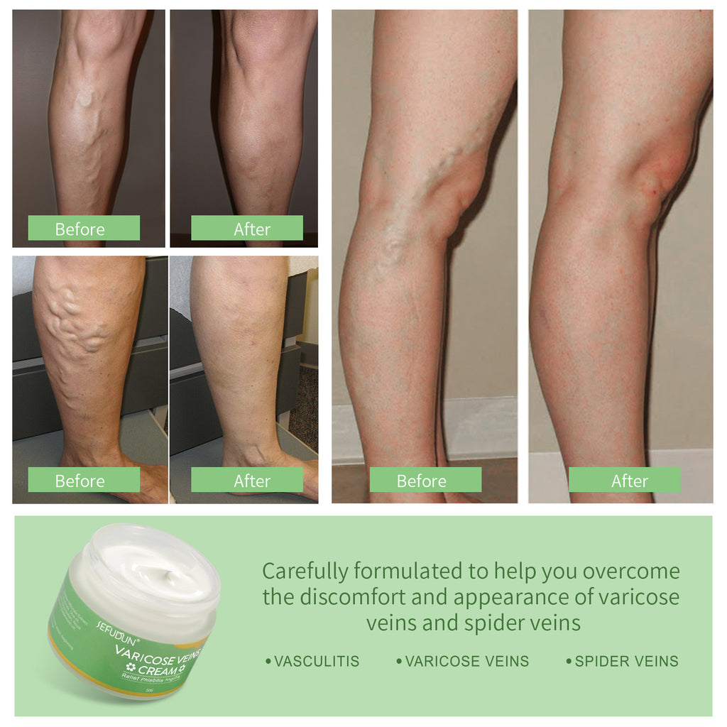 Vein Cream gegen Besenreiser & Krampfadern