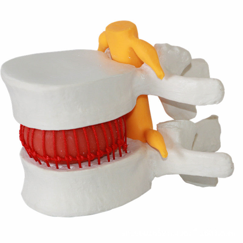 Demonstrationsmodell Intervertebraldisk-Hernie – Bild 5 | LuxeStyle