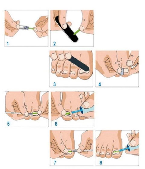 Nagelkorrektur-Pflaster-Set