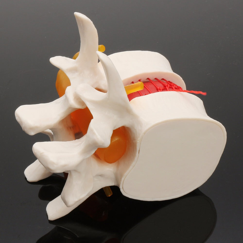 Demonstrationsmodell Intervertebraldisk-Hernie – Bild 3 | LuxeStyle