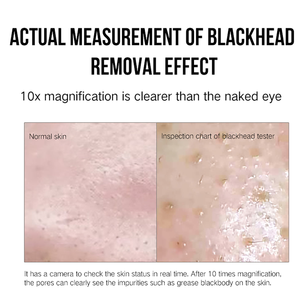 Blackhead-Entferner mit 3 Stufen & 1 Mio. Leica-Linse