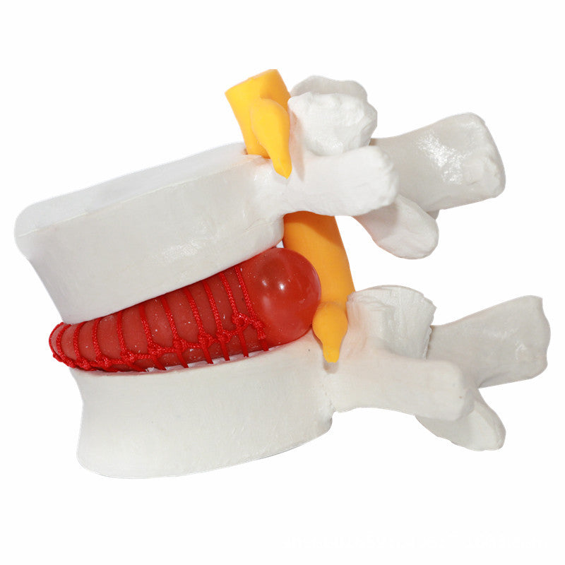 Demonstrationsmodell Intervertebraldisk-Hernie – Bild 4 | LuxeStyle