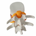 Demonstrationsmodell Intervertebraldisk-Hernie | LuxeStyle