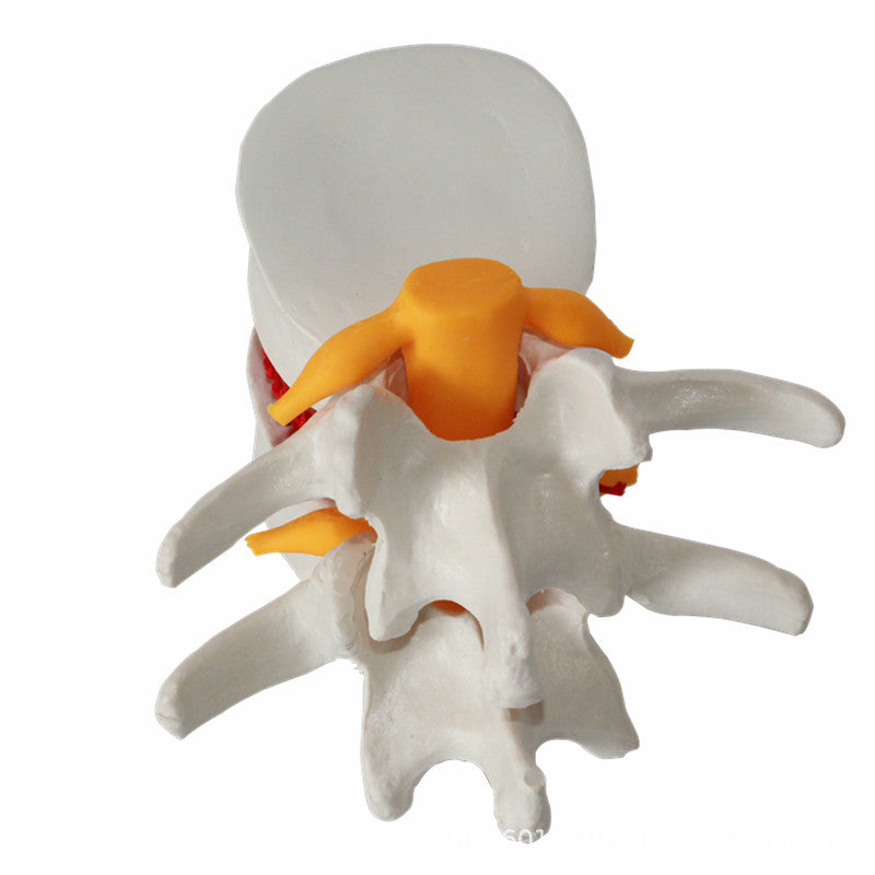 Demonstrationsmodell Intervertebraldisk-Hernie | LuxeStyle