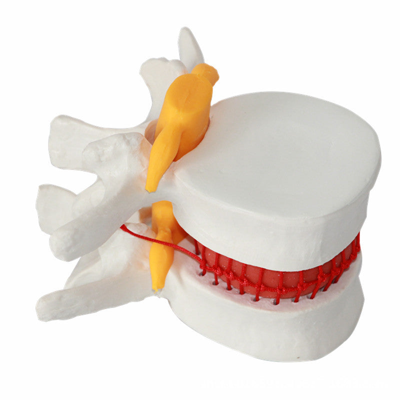 Demonstrationsmodell Intervertebraldisk-Hernie – Bild 6 | LuxeStyle