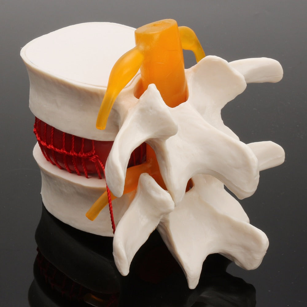 Demonstrationsmodell Intervertebraldisk-Hernie – Bild 8 | LuxeStyle