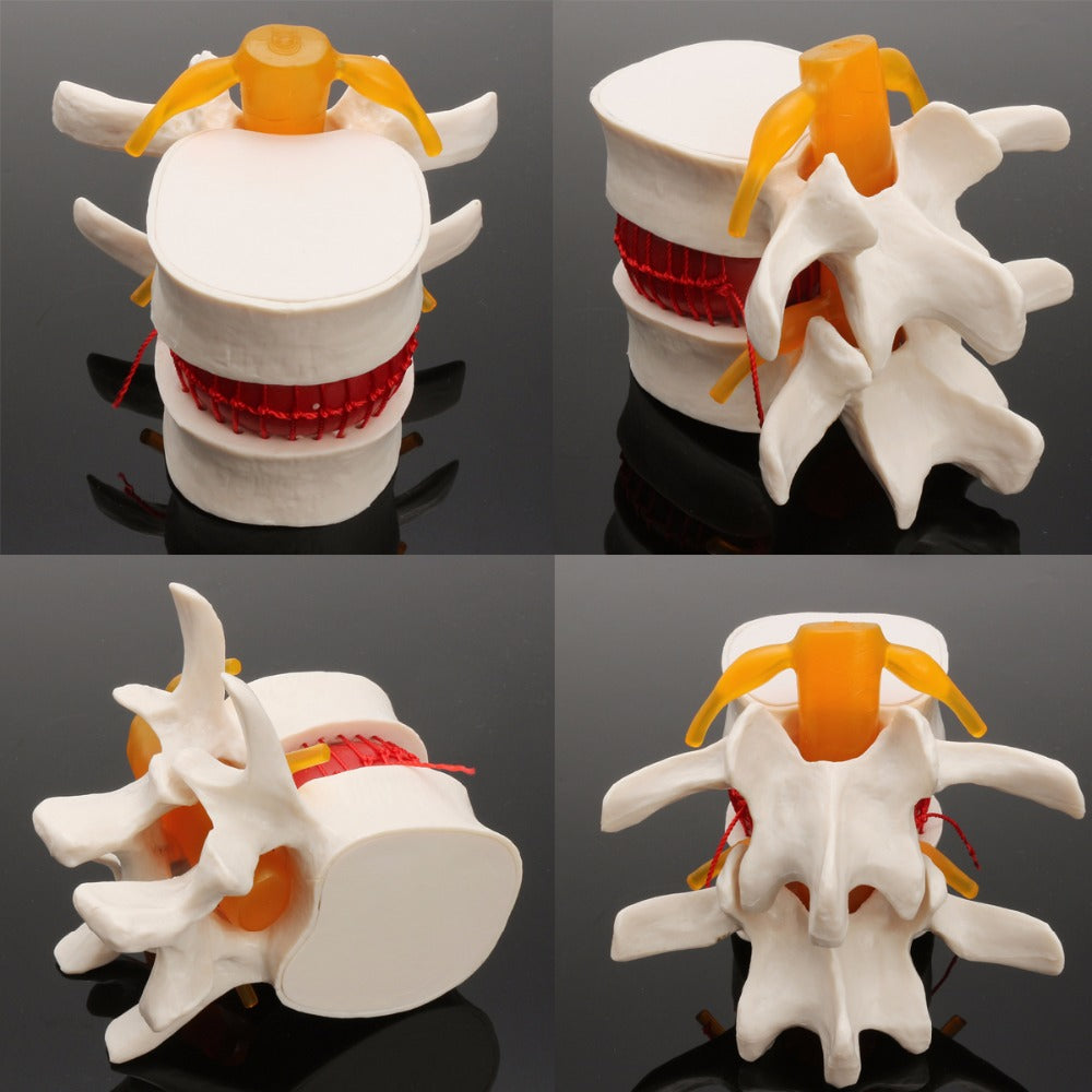Demonstrationsmodell Intervertebraldisk-Hernie – Bild 2 | LuxeStyle